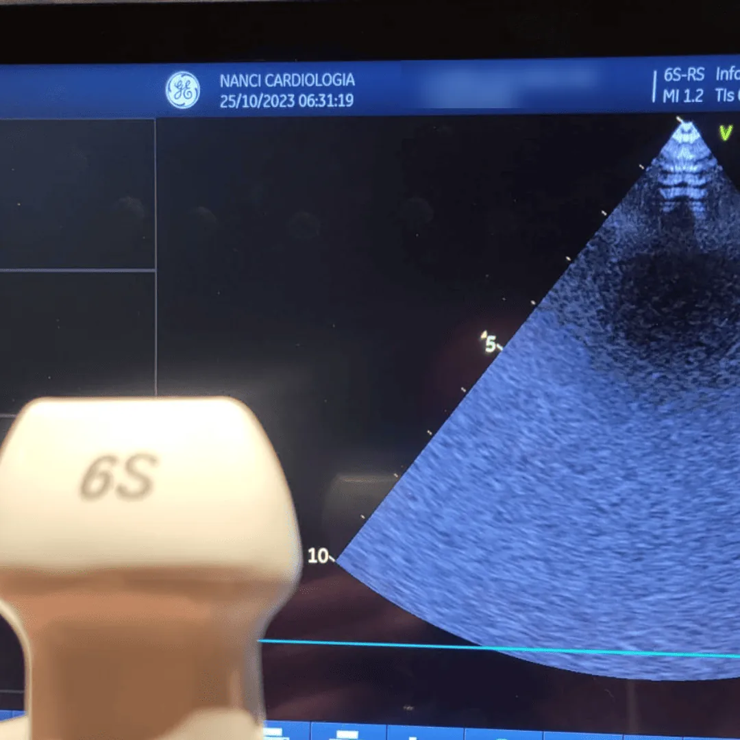 Tela do aparelho de ecocardiograma com a imagem do coração e o transdutor em primeiro plano